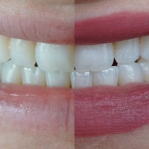 Smile Brilliant Teeth Whitening Testimonial | Madison Fichtl | Madison-fichtl.com